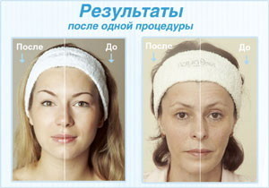 Кислородное омоложение лица фото до и после